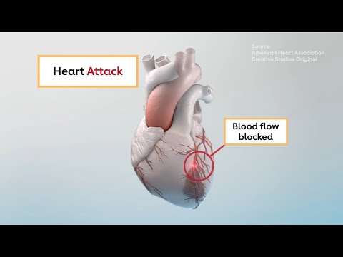 Heart attack vs. cardiac arrest: What's the difference?