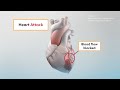 Heart Attack Vs Cardiac Arrest What S The Difference