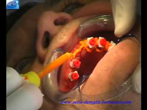 comment prendre empreinte dentaire