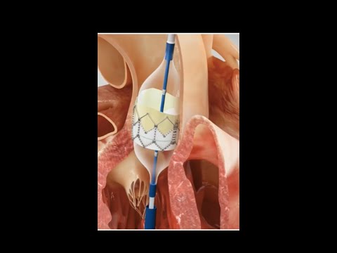 Transcatheter aortic valve implantation (TAVI) #science #shorts #anatomy