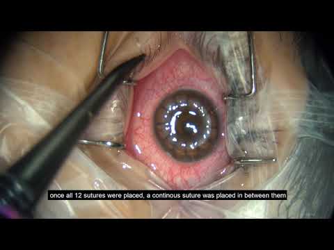 download lagu mp3 mp4 Corneal Transplant Surgery In India, download lagu Corneal Transplant Surgery In India gratis, unduh video klip Corneal Transplant Surgery In India