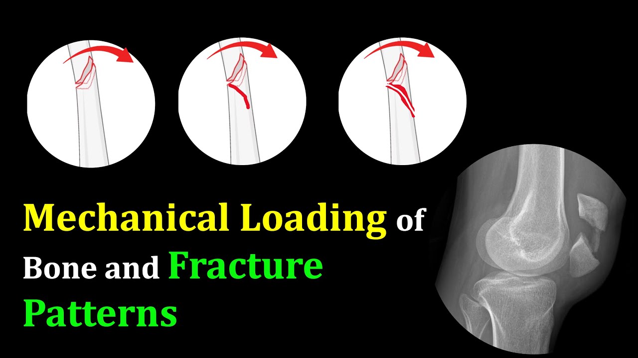 Mechanical Loading and Bone Fracture Patterns
