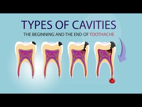 Three types of cavities. Minimally invasive treatments