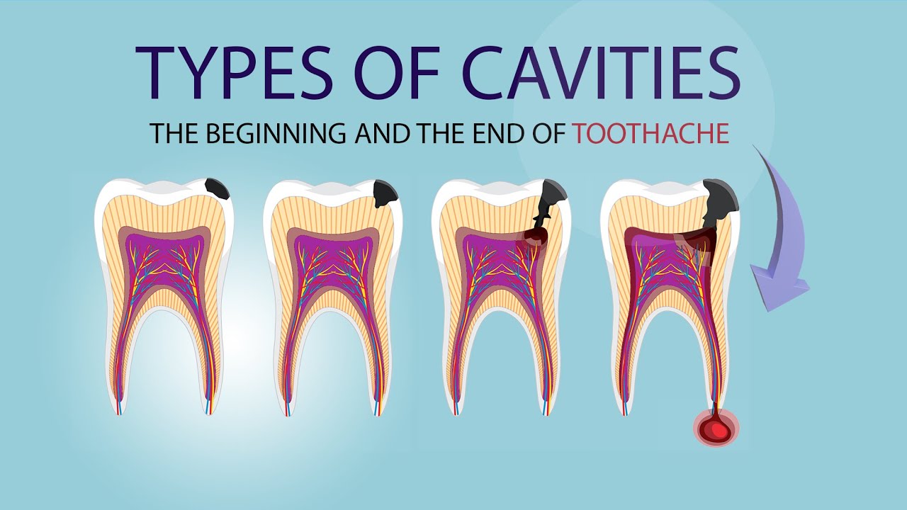 Three types of cavities. Minimally invasive treatments