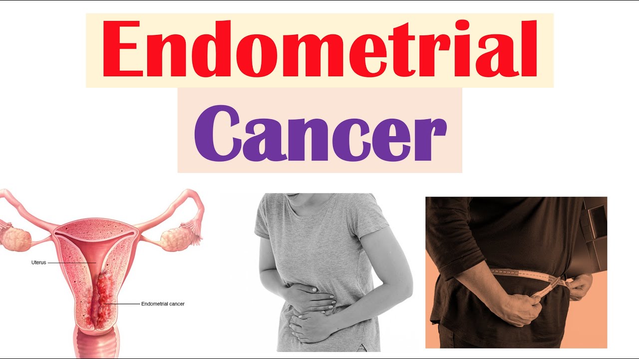 Endometrial Cancer | Risk Factors, Pathogenesis, Signs & Symptoms, Diagnosis, Treatment, Prevention