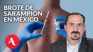 ¿Por qué no vacunan a mayores de 50? UNAM explica la lógica en medio del brote de sarampión