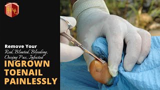 ngrown Toenail Surgery. Ingrown Toenails Can Be Painful And They Usually Worsen In Stages.