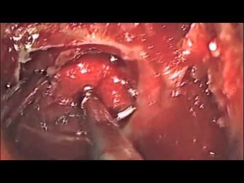 Endoscopic Removal of Pituitary Macroadenoma with Visual Loss