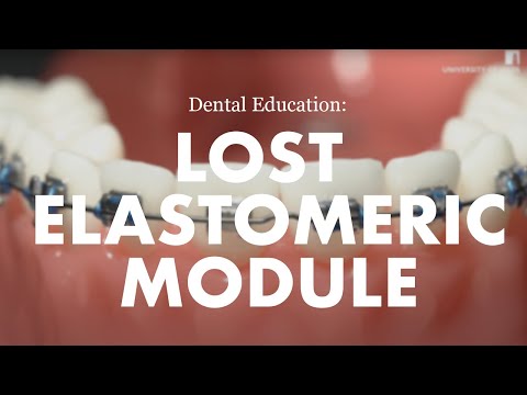 Orthodontic Emergencies: How to replace a lost elastomeric module on a fixed appliance (brace)