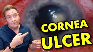 Corneal Ulcer or NOT: Symptoms, Cause & Treatment