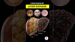 5 Skin Signs of Liver Damage You Shouldn't Ignore #shorts #liverhealth