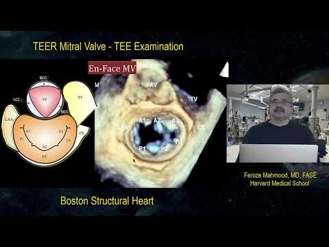 3D Examination of the Mitral Valve