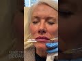Lip Filler Technique To Outline the Vermillion Border & Add Volume