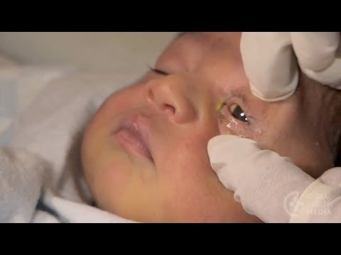 Eye infections - newborn care