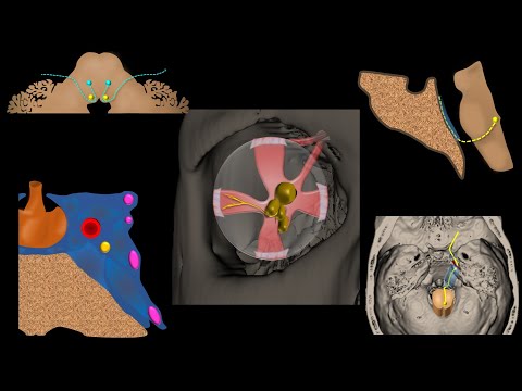 The SIX syndromes of the SIXTH cranial nerve