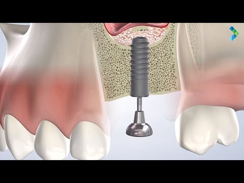Bone Grafting in Danbury CT | Greater Connecticut Oral & Dental Implant Surgery