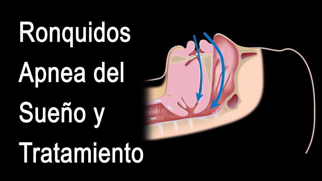 Watch Ronquidos, Apnea Obstructiva del Sueño y Tratamiento, Animación. Alila Medical Media Español. Now Ronquidos, Apnea Obstructiva del Sueño y Tratamiento, Animación. Alila Medical Media Español.