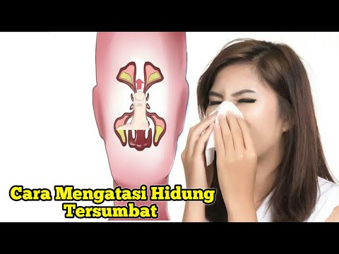 download lagu mp3 mp4 Cara Hilangkan Hidung Tersumbat Dengan Cepat, download lagu Cara Hilangkan Hidung Tersumbat Dengan Cepat gratis, unduh video klip Cara Hilangkan Hidung Tersumbat Dengan Cepat