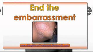 preview picture of video 'how to treat ringworm in humans - treating ringworm - ringworm treatment'