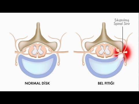 Bel fıtığının belirtileri nelerdir? - Prof. Dr. Onur Yaman (Nöroşirürji Uz.)