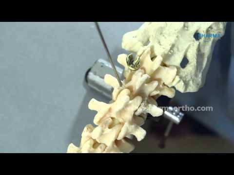 Titanium minimal invasive poly axial pedicle screw