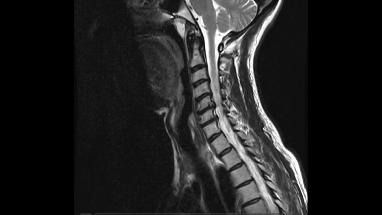 Anatomía RM Cervical