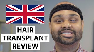 Hair Transplant Patient Review: Hello UK! Ramkumar’s Hair Transplant Experience at AEK Hair Clinic