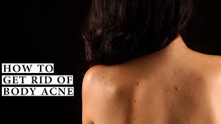 How To Get Rid Of Body Acne