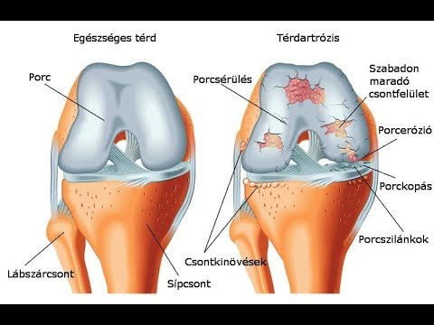 zsálya térd artrózisával