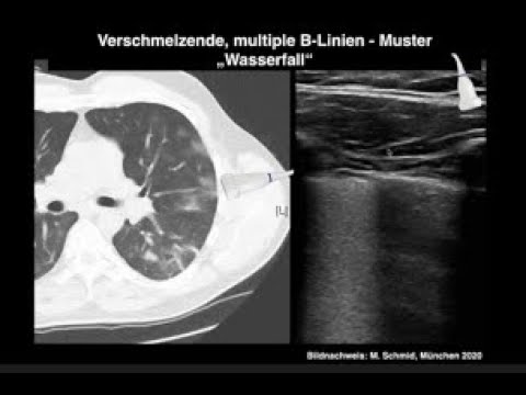 , title : 'B-Probleme: Lungensono bei COVID-19 Pneumonie von Erika Glöckner'