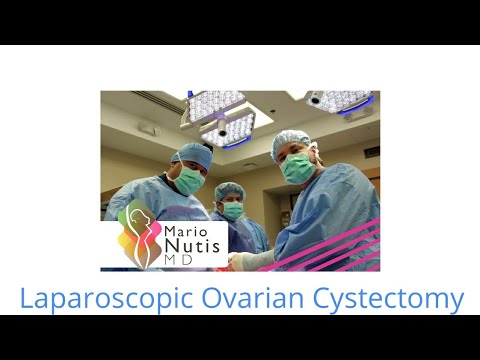 laparoscopic cystectomy ovarian