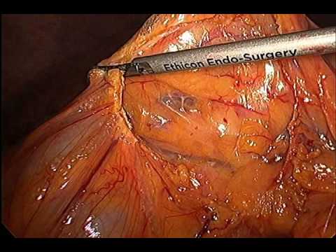 Laparoscopic Extended Transversectomy With Partial Gastrectomy 