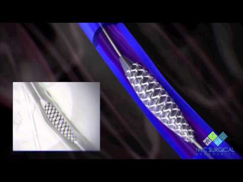 Animation of Venogram, Angioplasty, Stent, IVUS, Vena Cava Filter