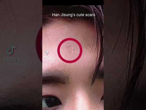 his scars are so cute 🥰💖🐿️ #kpop #straykids #hanjisung #notmyvid #nohate