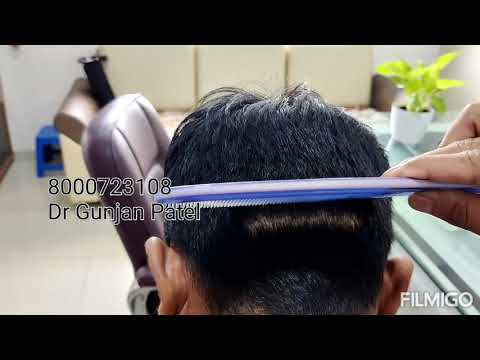 Hair transplant, vadodara, bharuch,surat, anand- contact 8000723108- Dr Gunjan Patel