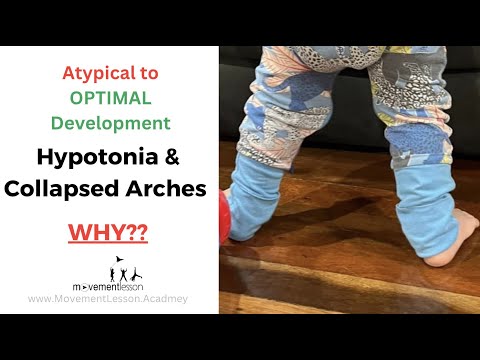 Atypical Development Baby Hypotonia, Low tone & Walking with Collapsed Arches - for Worried Parents