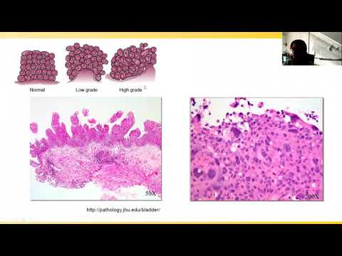 Greenberg Bladder Cancer Institute Virtual Grand Rounds: Clinical Trials and Immunotherapy