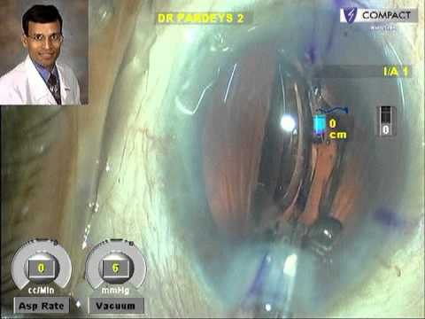 Managing Astigmatism During Cataract Surgery