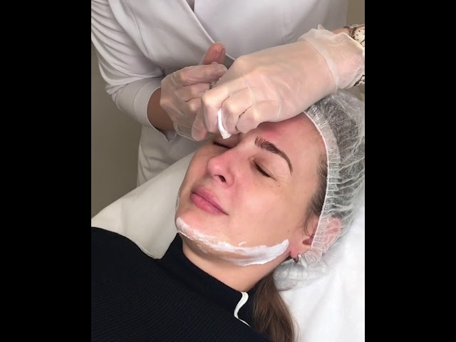 Коррекция морщин ботоксом