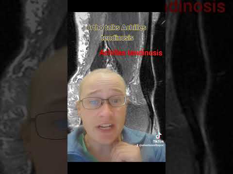 Ortho talks Achilles tendinosis (scarring)