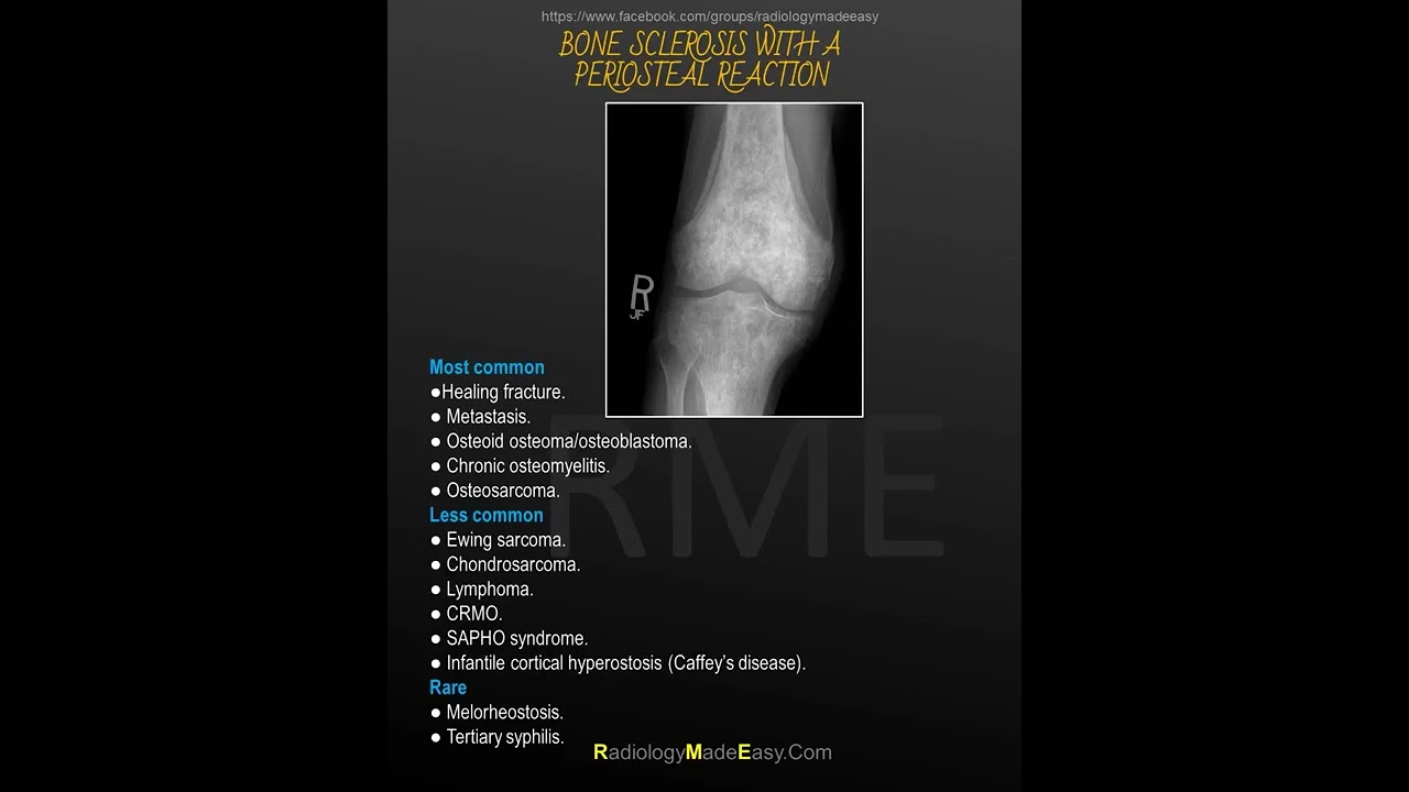 SOLITARY SCLEROTIC BONE LESION WITH A LUCENT CENTRE