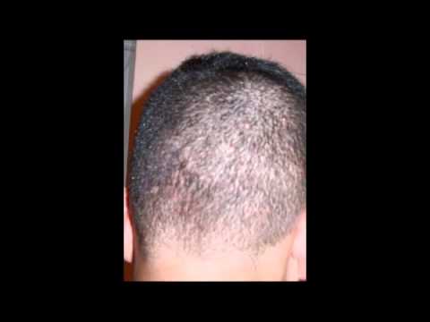 La sangre a atopicheskom la dermatitis Se puede las semillas a la eccema