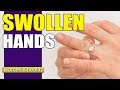 What Causes Swollen Hands? | Reduce Swelling