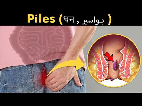 What Happens In Piles (Haemorrhoids, Bawaseer (بواسیر) | Symptoms, Causes And Treatment (Urdu/Hindi)