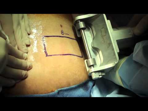 Live Surgery Split Thickness Skin Graft