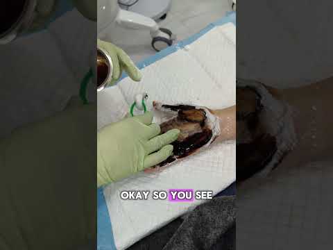 Stop Excessive Palm Sweating | Hyperhidrosis Treatment Result