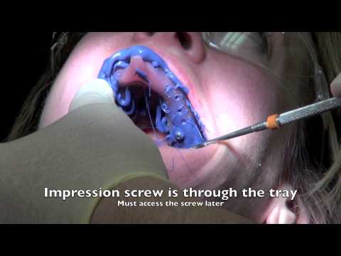 Dental Implant - Impression and Insertion of crown