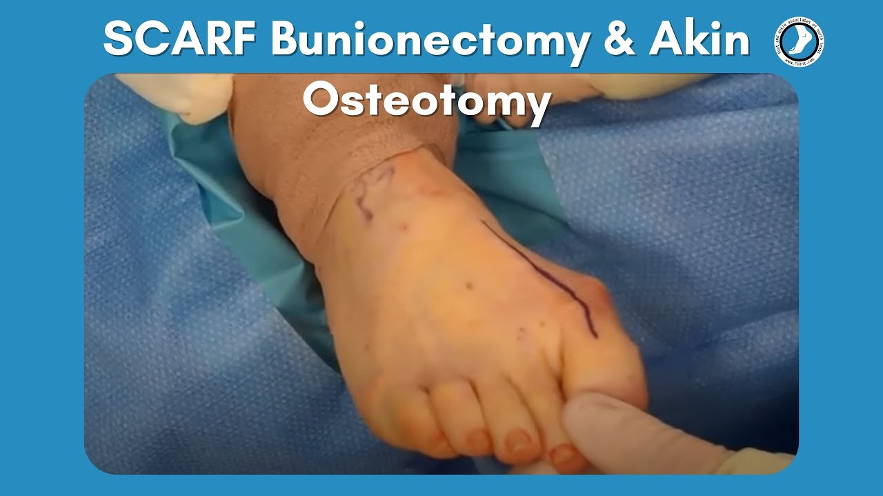 SCARF Bunionectomy and Akin Osteotomy | Foot and Ankle Associates of