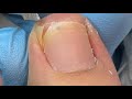 Amazing sharp toenail treatment skill