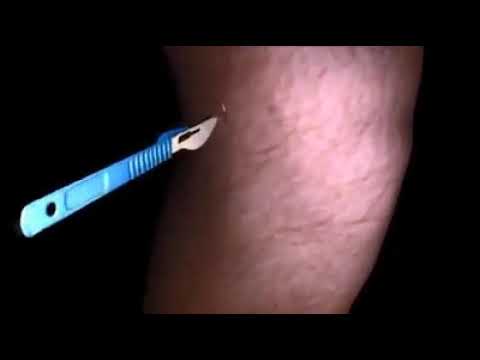 DËMTIMI I LIGAMENTIT KRUCIAT ANTERIOR TEK SPORTISTËT